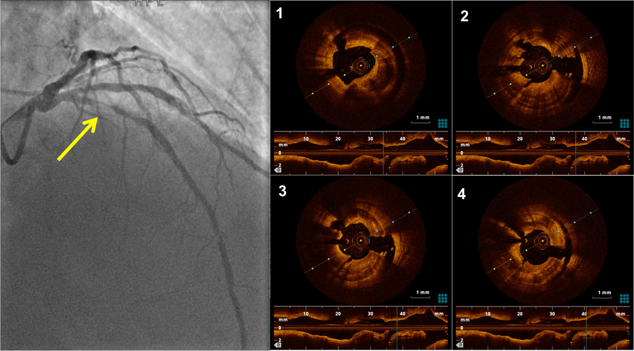 From single debulking techniques to combined approaches: a review of bailout strategies in heavily calcified coronary lesions
