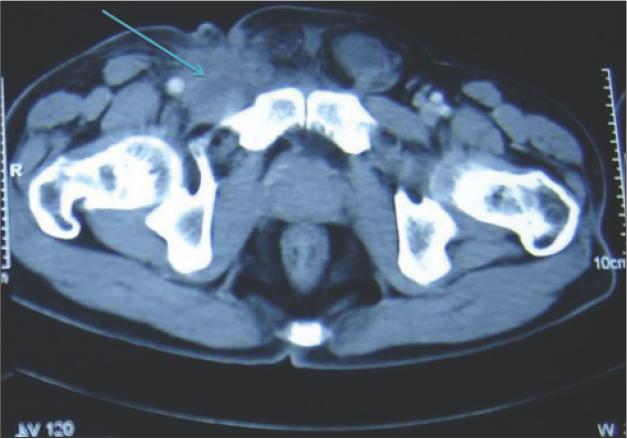 Metastatic Inguinal Lymph Nodes With Two Different Histological Types