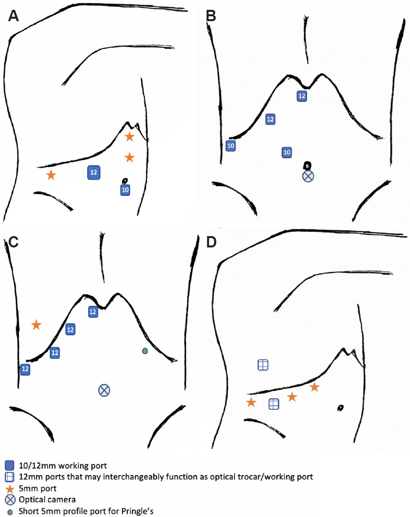 Patient And Port Positioning In Laparoscopic Liver Resections