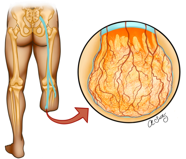 Management Of Symptomatic Neuromas A Narrative Review Of The Most Common Surgical Treatment