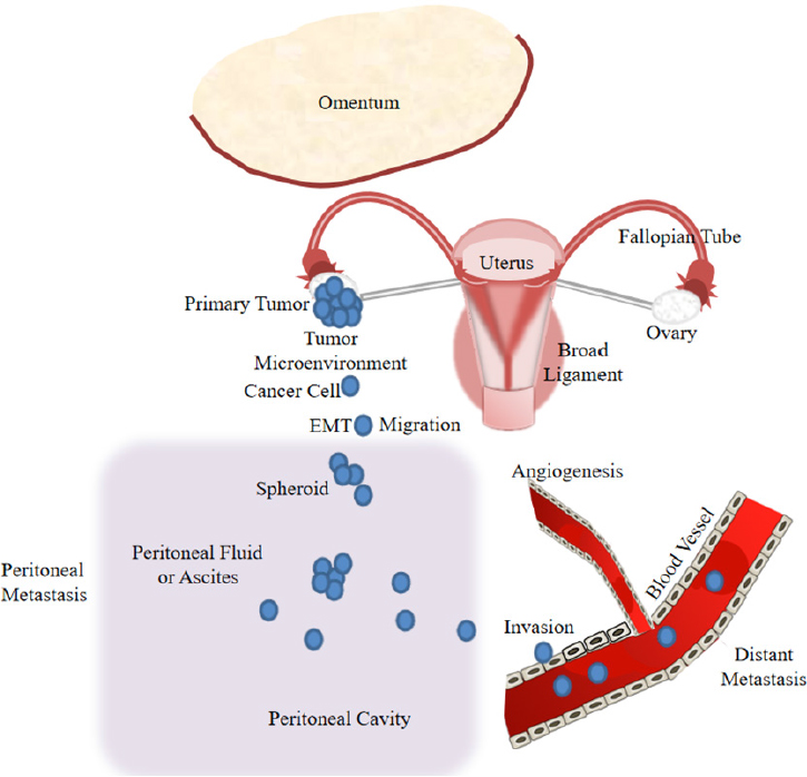 ovarian cancer lymphatic spread