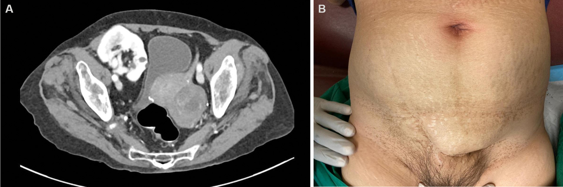 kidney transplant donor scar