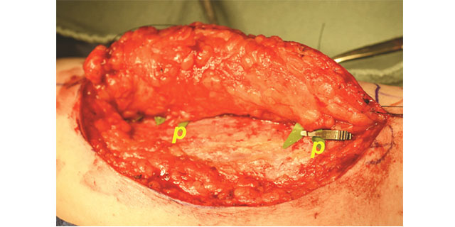 Exploring personalized postoperative non-invasive tissue oximetry