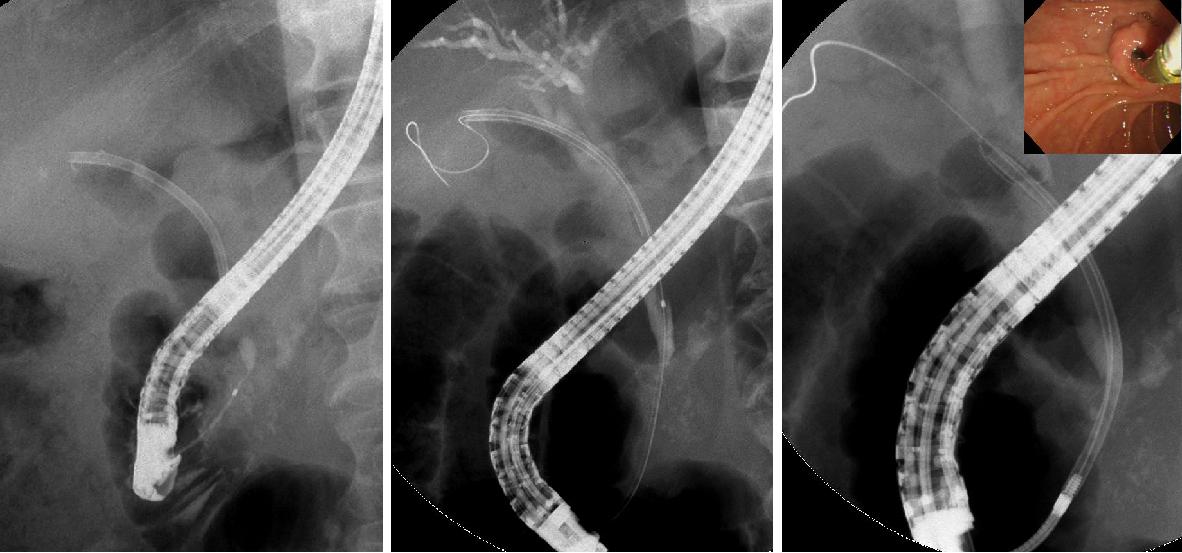 ercp stent