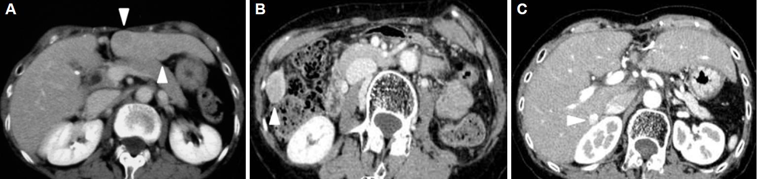 Case Report Of The Fourth Laparoscopic Liver Resection And Review Of ...