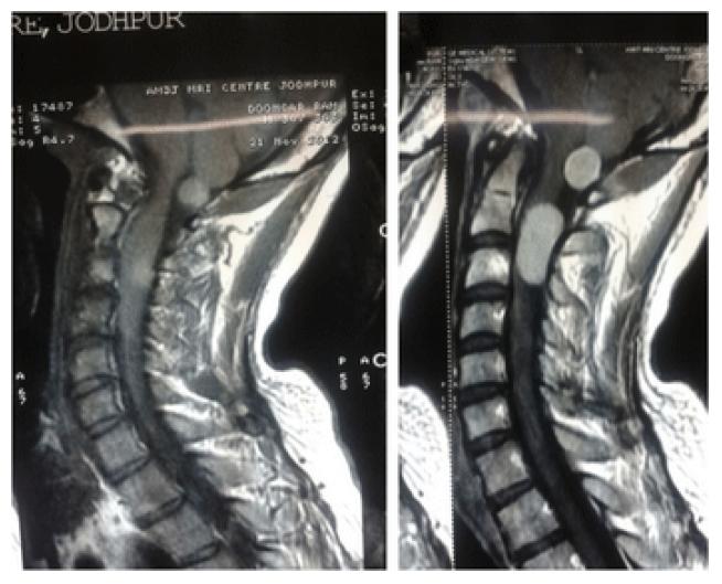 Ct Scan Cervical Spine Images Ct Scan Machine