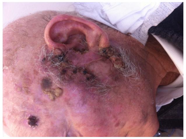 Merkel Cell Carcinoma Pictures - Diagnosis and Management ...