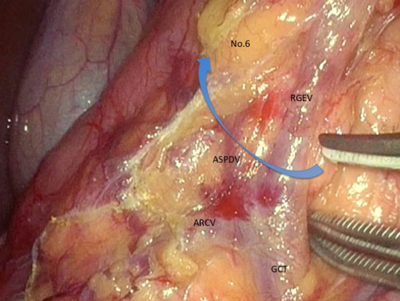 Laparoscopic lymph nodes dissection for advanced gastric cancer: the