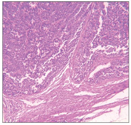 Metastatic high-grade neuroendocrine tumor of mandible