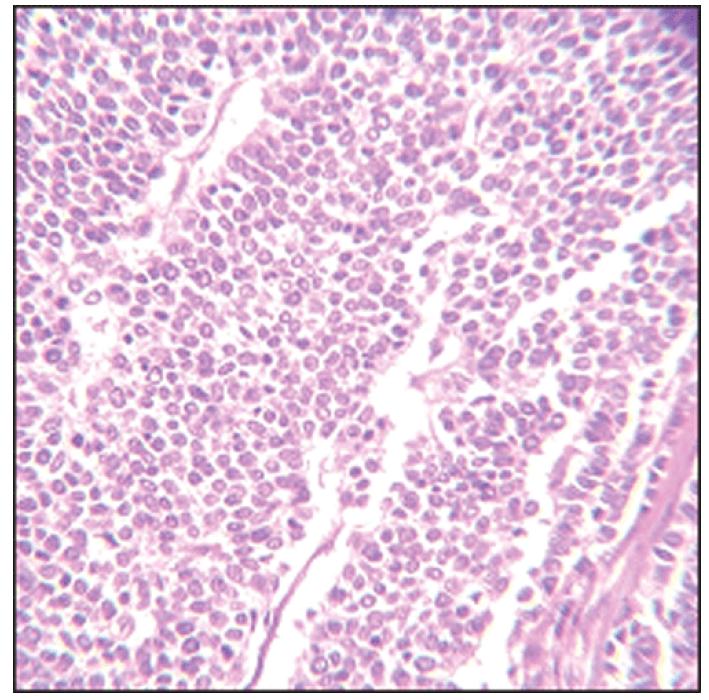 High grade neuroendocrine carcinoma