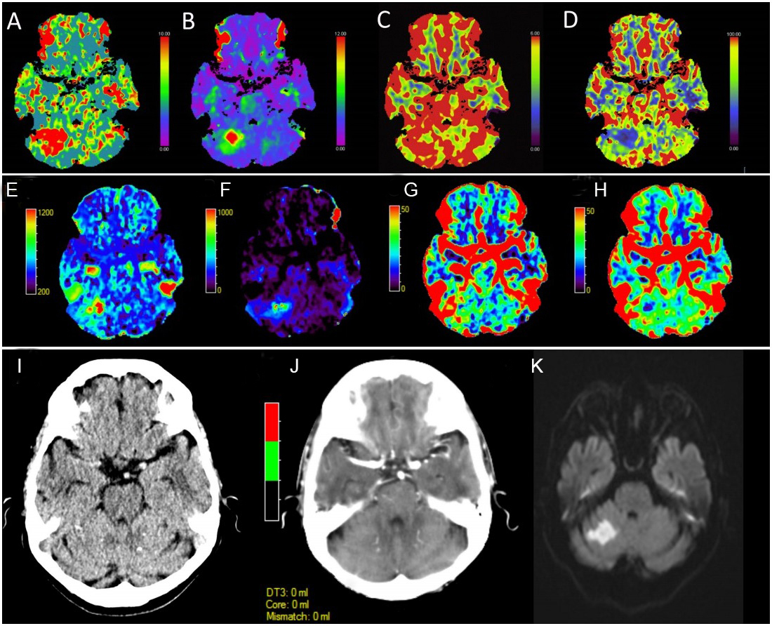 Review of CT perfusion and current applications in posterior ...