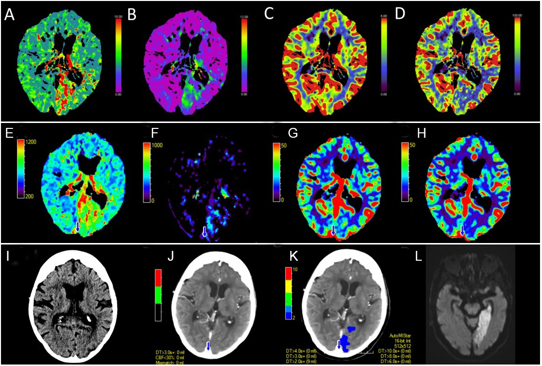 Review of CT perfusion and current applications in posterior ...