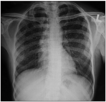 Concurrent occurrence of both intracranial and intramedullary tuberculomas