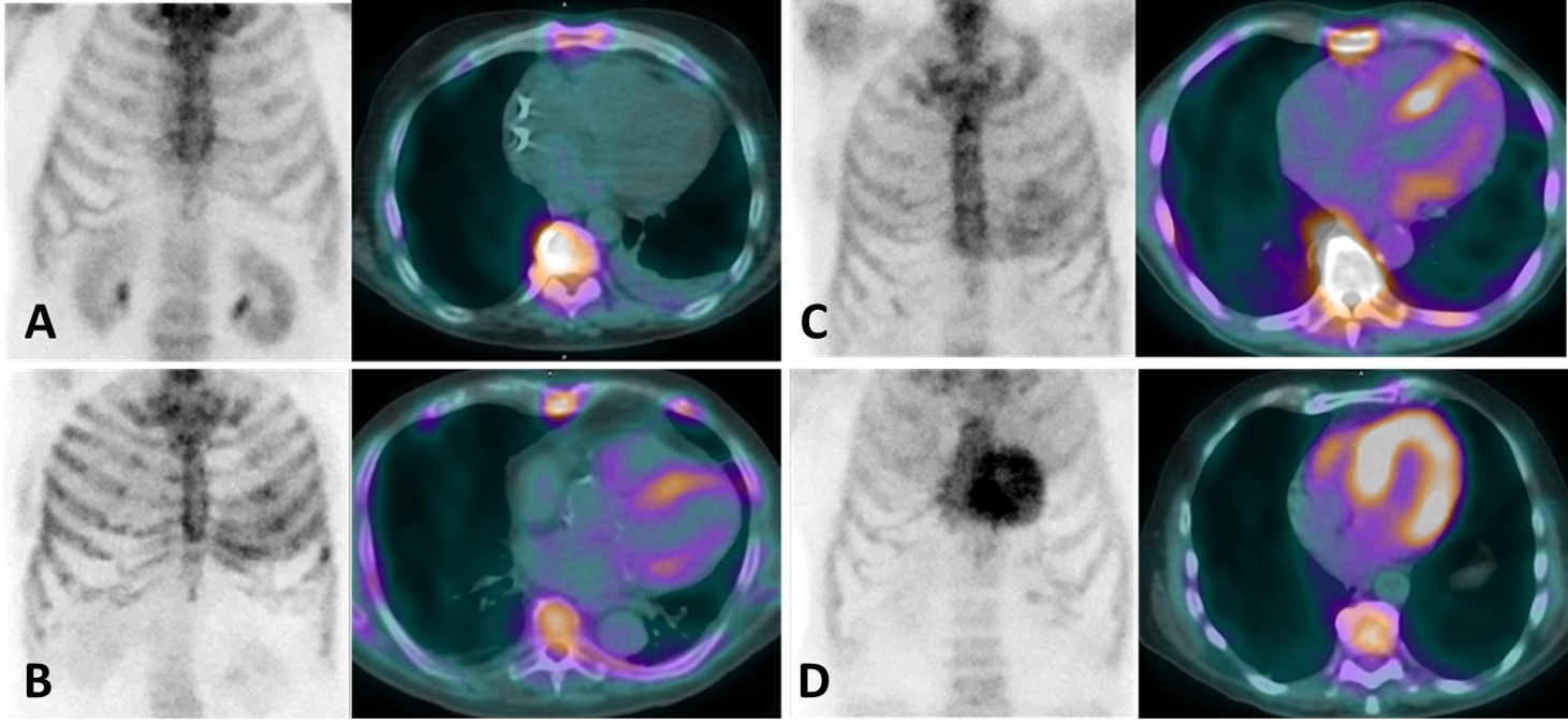 Nuclear medicine techniques for the diagnosis of cardiac amyloidosis ...