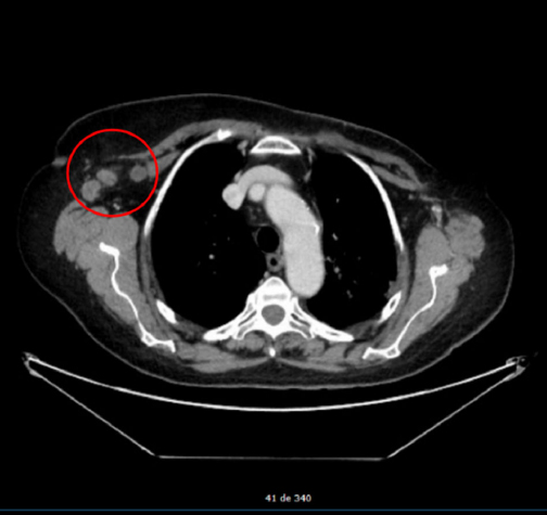 Contralateral axillary metastasis: is surgical treatment the best option?