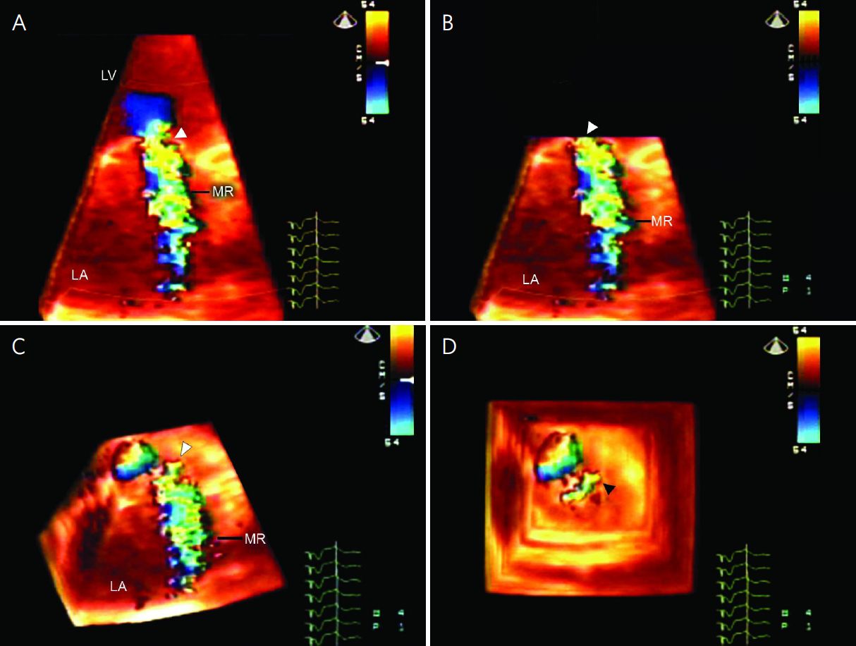 Echocardiographic Evaluation Of Mitral Valve Regurgitation 9717