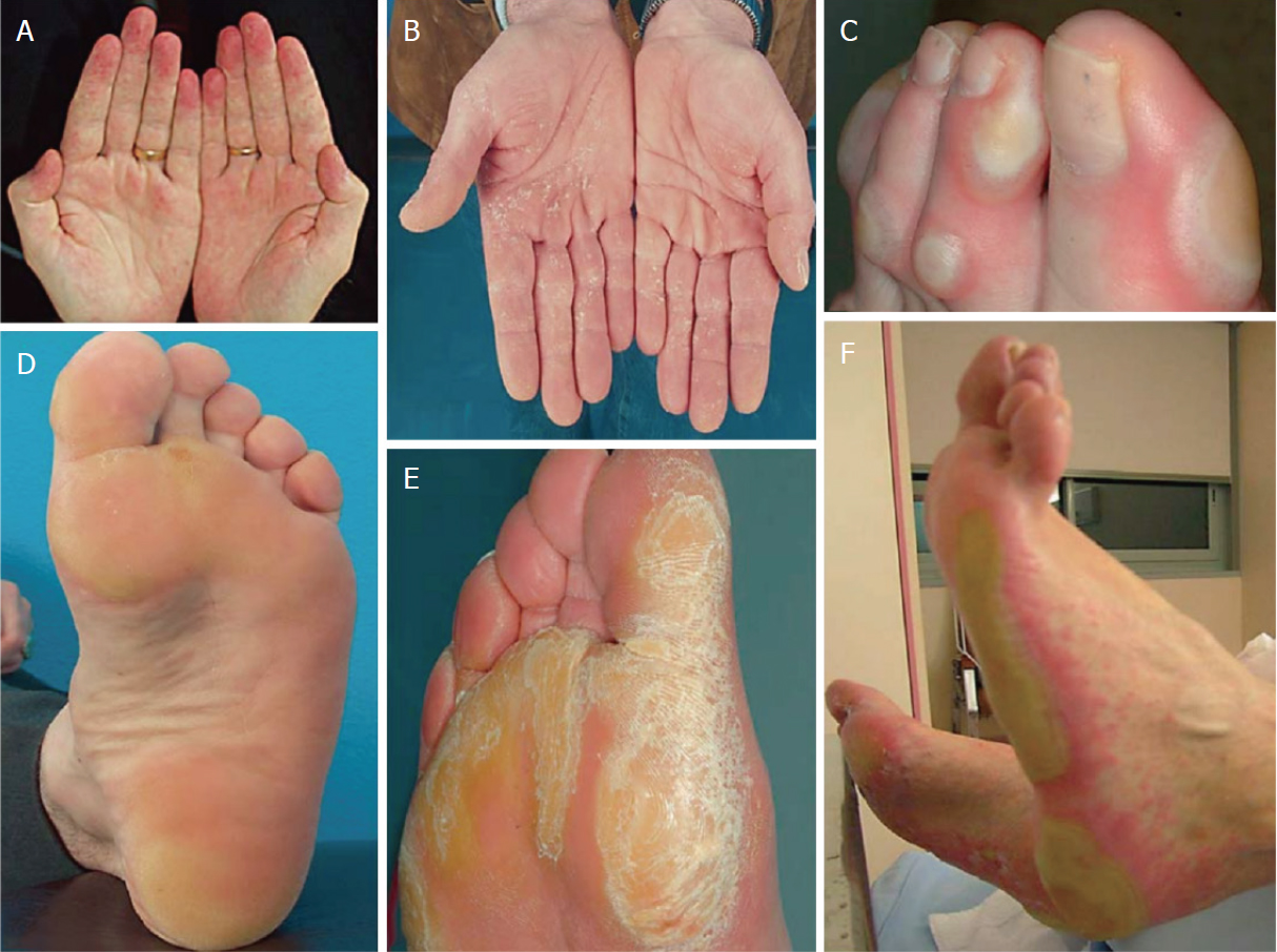Cutaneous toxicities of targeted therapies in the treatment of hepatocellular carcinoma