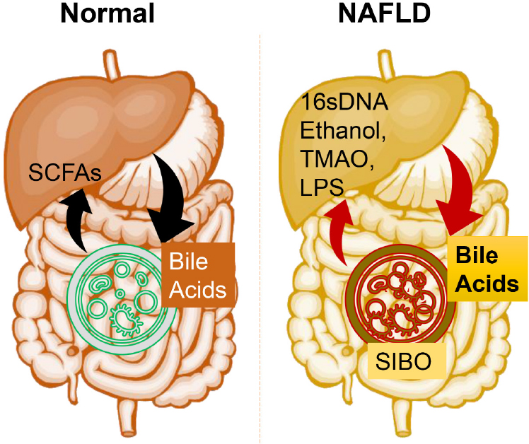 Gut Microbiota And Their Metabolites In The Progression Of Non ...