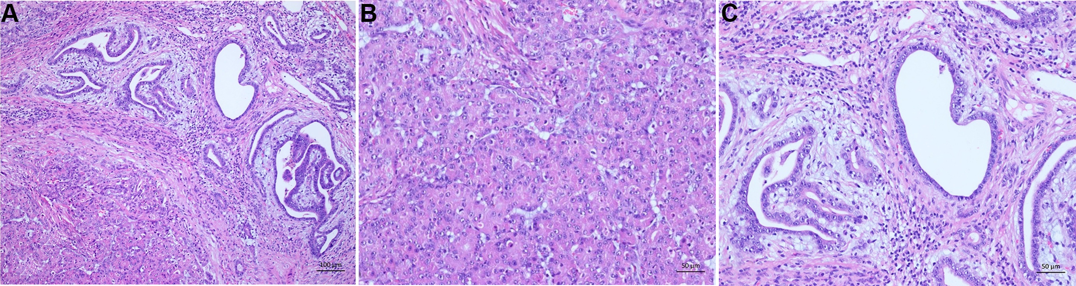 hepatocellular carcinoma histology