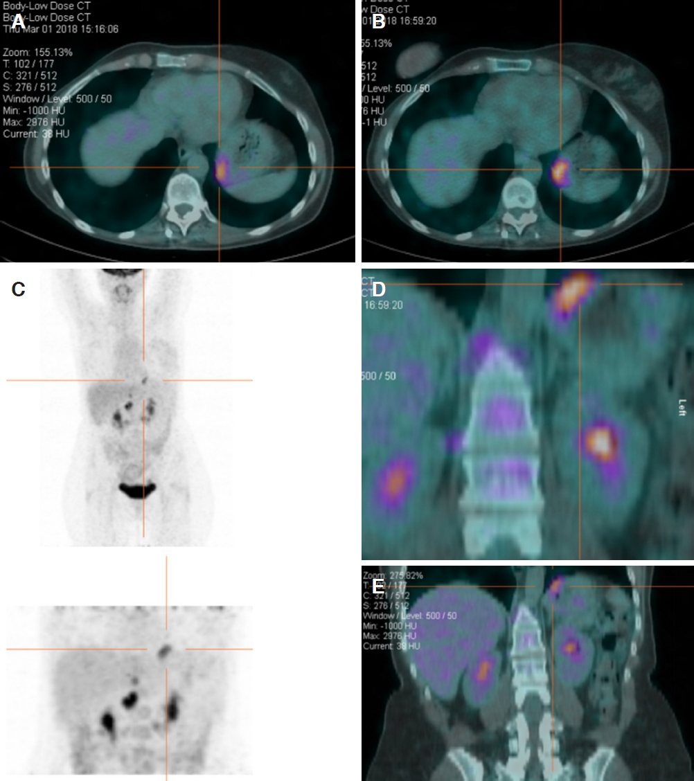 Breast Cancer Metastasis To The Stomach