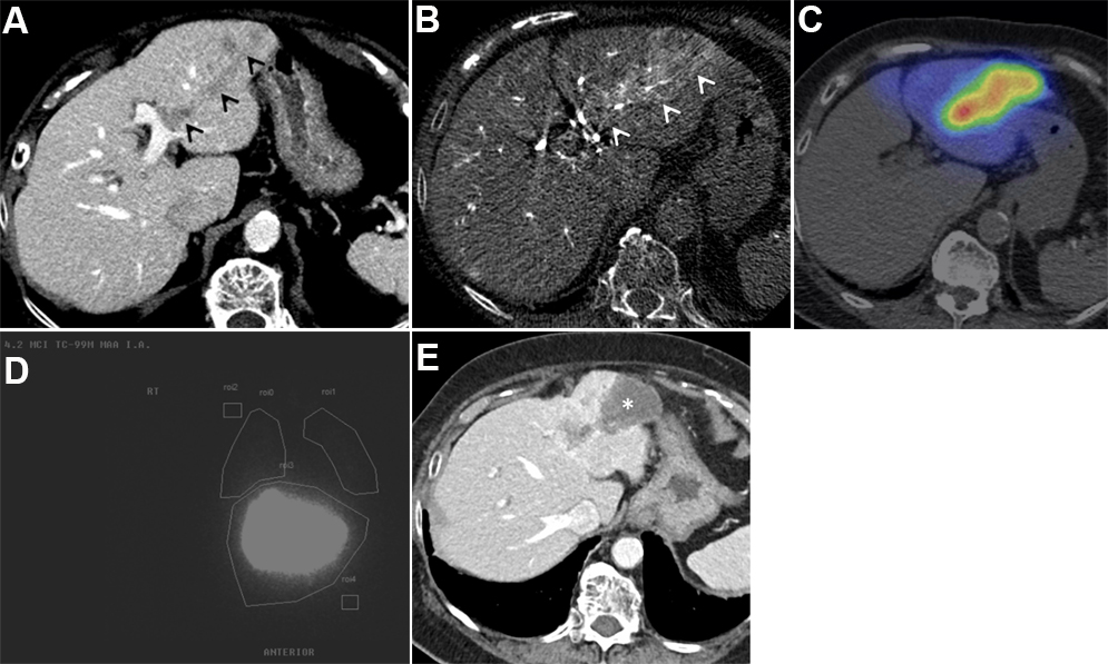 Advances in Y-90 radioembolization for the treatment of hepatocellular  carcinoma