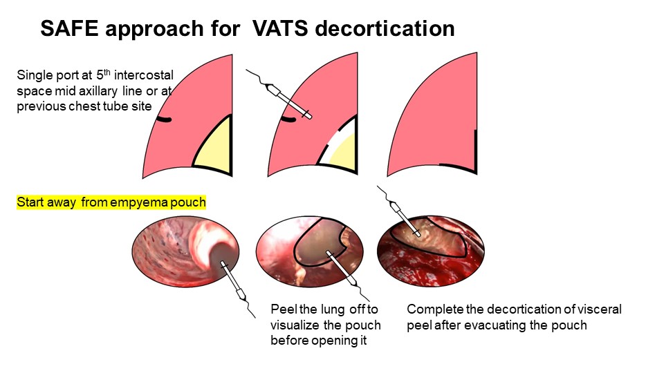 Uniportal thoracoscopic decortication start away from empyema approach