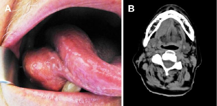 Papillary Cystadenocarcinoma Of The Sublingual Gland Case Report