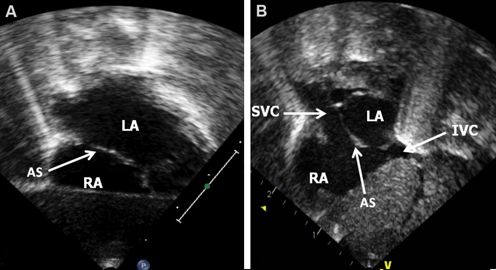 Echocardiography: an overview - part I