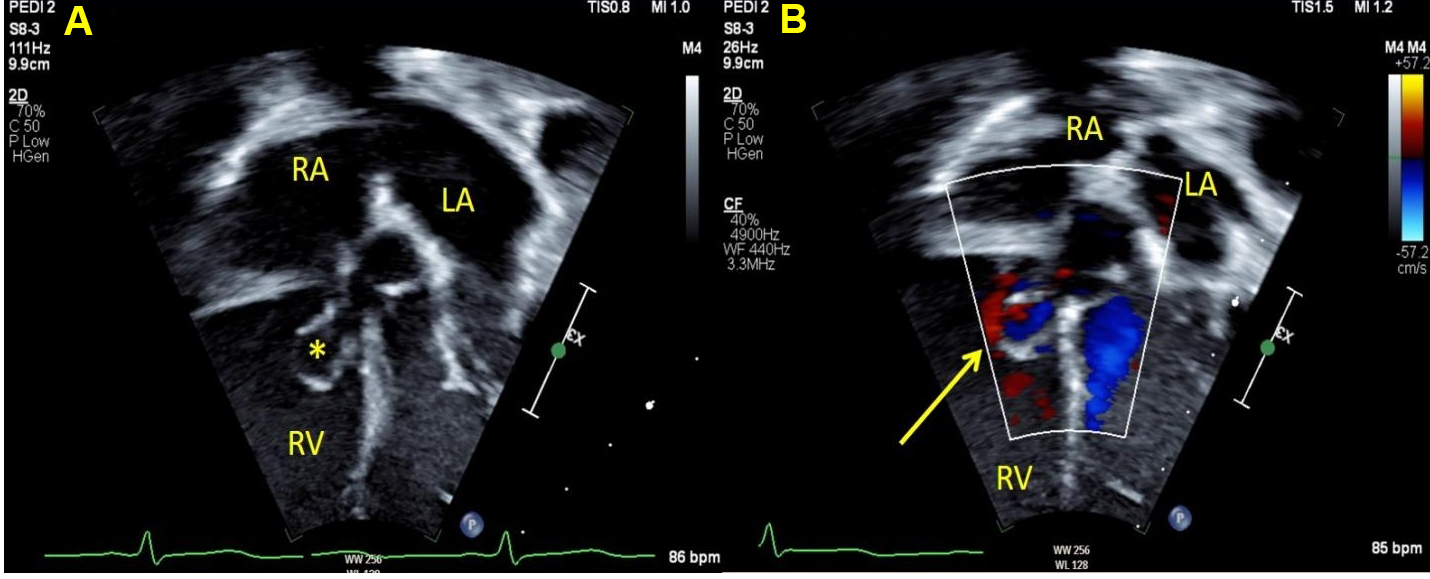 Chapter: imaging of atrial and ventricular septal defects