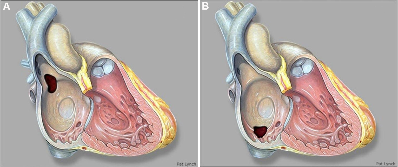Chapter Imaging Of Atrial And Ventricular Septal Defects