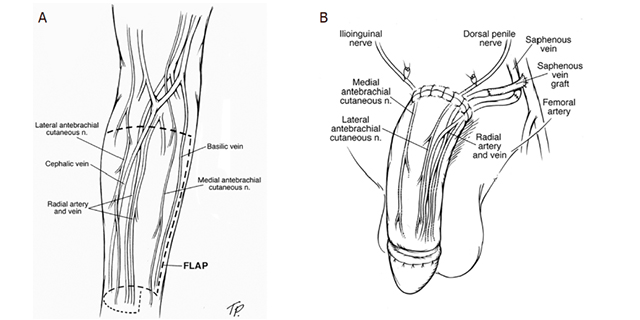 a Large penile skin defect after debridement at full stretch. b Penile