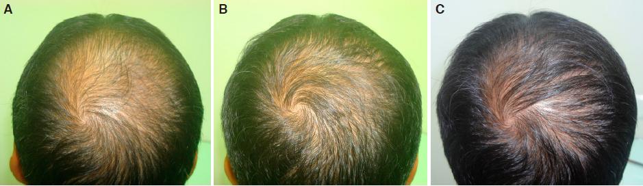 Deficiency hair reversal zinc loss Zinc deficiency