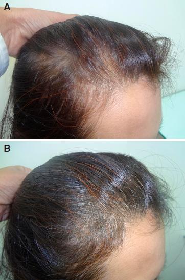 Controlled Clinical Trial For Evaluation Of Hair Growth With