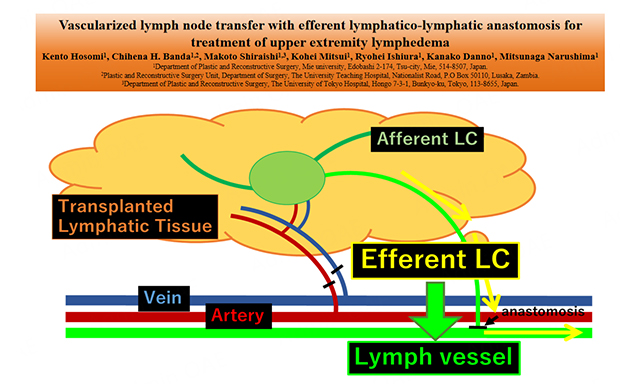 Liacsy™ Lymphsis Ionization Support Bra - Kūʻai i kēia lā Loaʻa iā 55% ka  uku hoʻemi - MOLOOCO