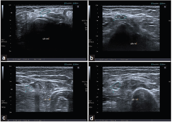 Role of the neuromuscular ultrasound in the diagnostic of the ...