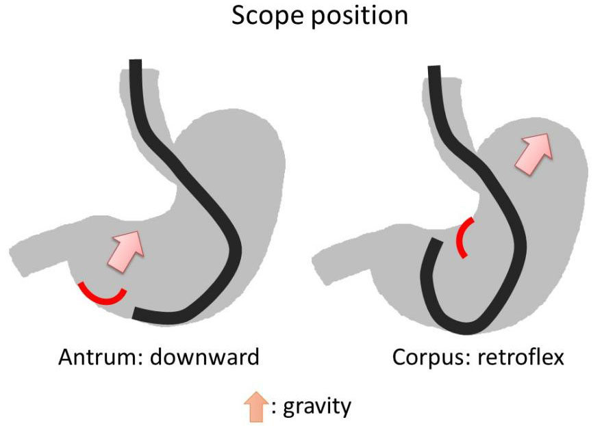 Endoscopic Submucosal Dissection For Early Gastric Adenocarcinoma