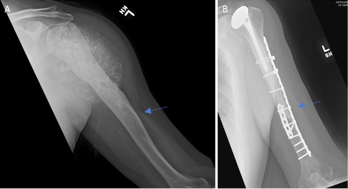 Proximal humerus reconstruction in orthopedic oncology