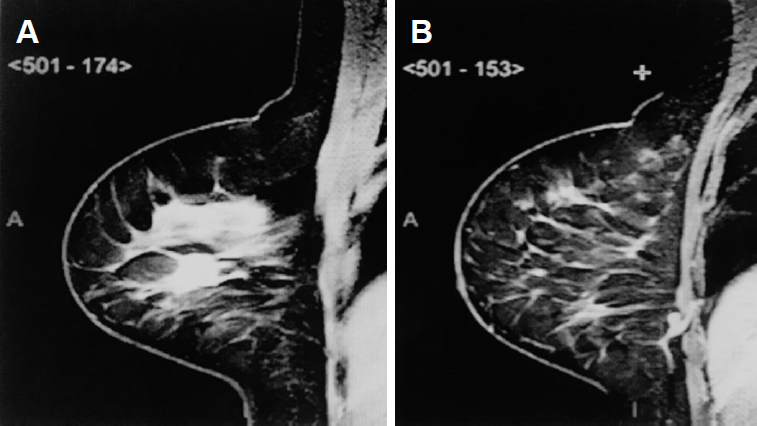 deep axillary sentinel node