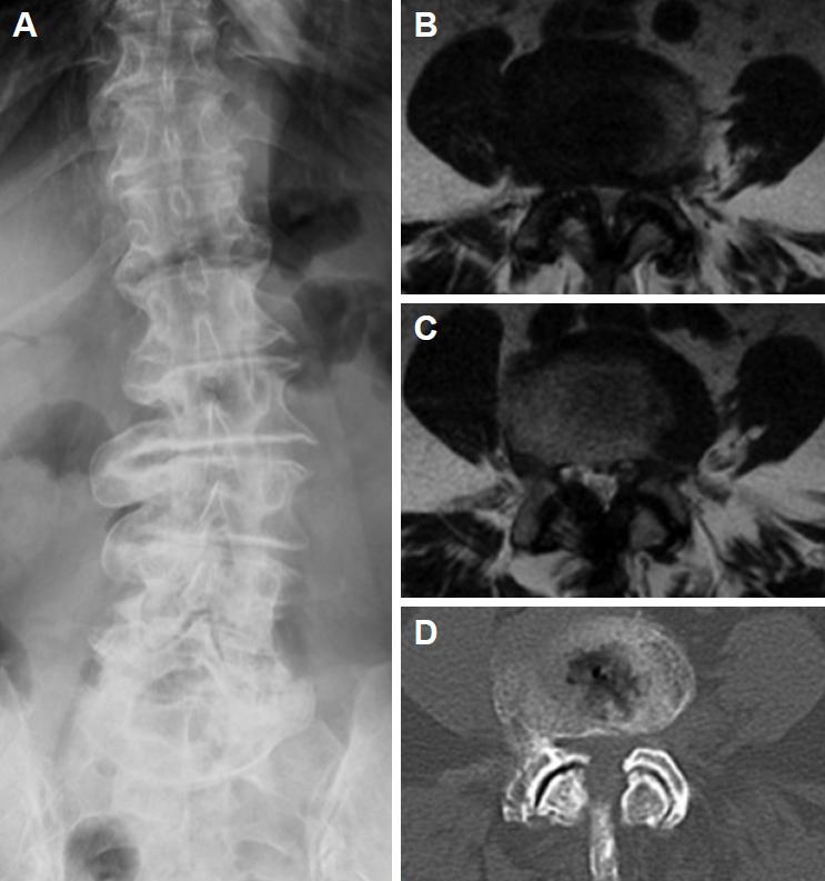 Percutaneous Endoscopic Lumbar Laminectomy