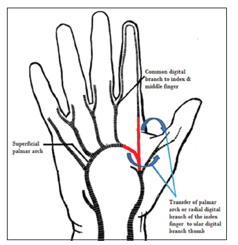 index thumb artery digital radial finger palmar arch revascularization literature experience options review schematic representing transfer figure