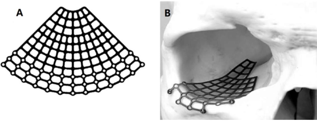 Materials To Facilitate Orbital Reconstruction And Soft Tissue
