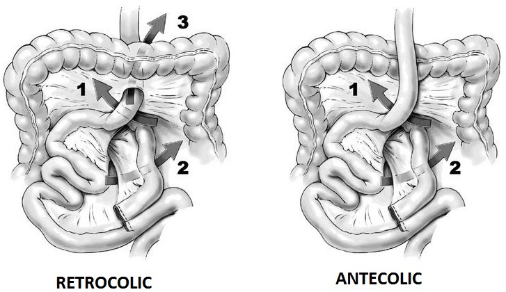 Prevention And Management Of Internal Hernias After Bariatric Surgery An Expert Review