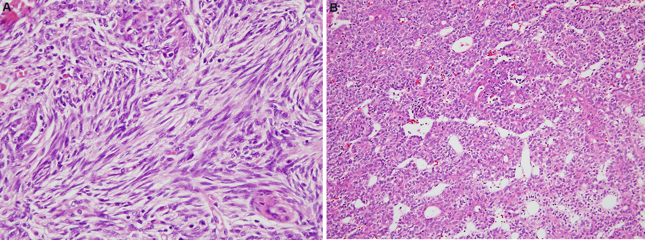 The WHO 2021 Thymoma Classification: A Work In Progress